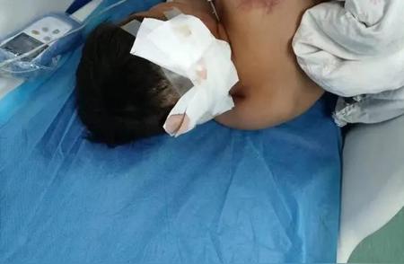 湖南10岁男孩被阿拉斯加犬攻击，三天后仍在重症监护室接受治疗